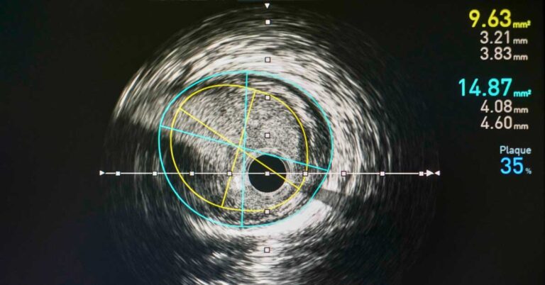 IVUS